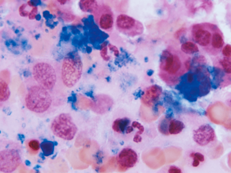 A photomicrograph of a Prussian blue stained bone marrow sample, revealing a normal amount of iron stores.