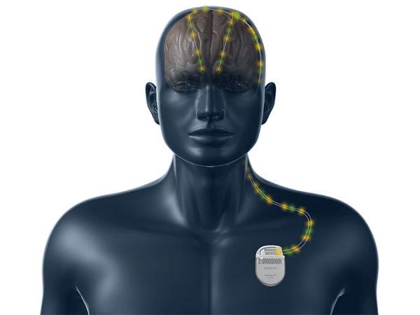 Study finds deep-brain stimulation shifts people out of negative ‘cycles’ of mental illness