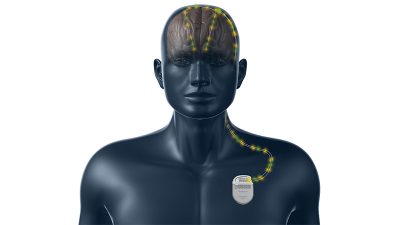 A new study has found that deep brain stimulation, a surgical procedure that uses electrical impulses to treat neurological disorders, can enhance psychological flexibility in people with depression, anxiety or obsessive-compulsive disorder.